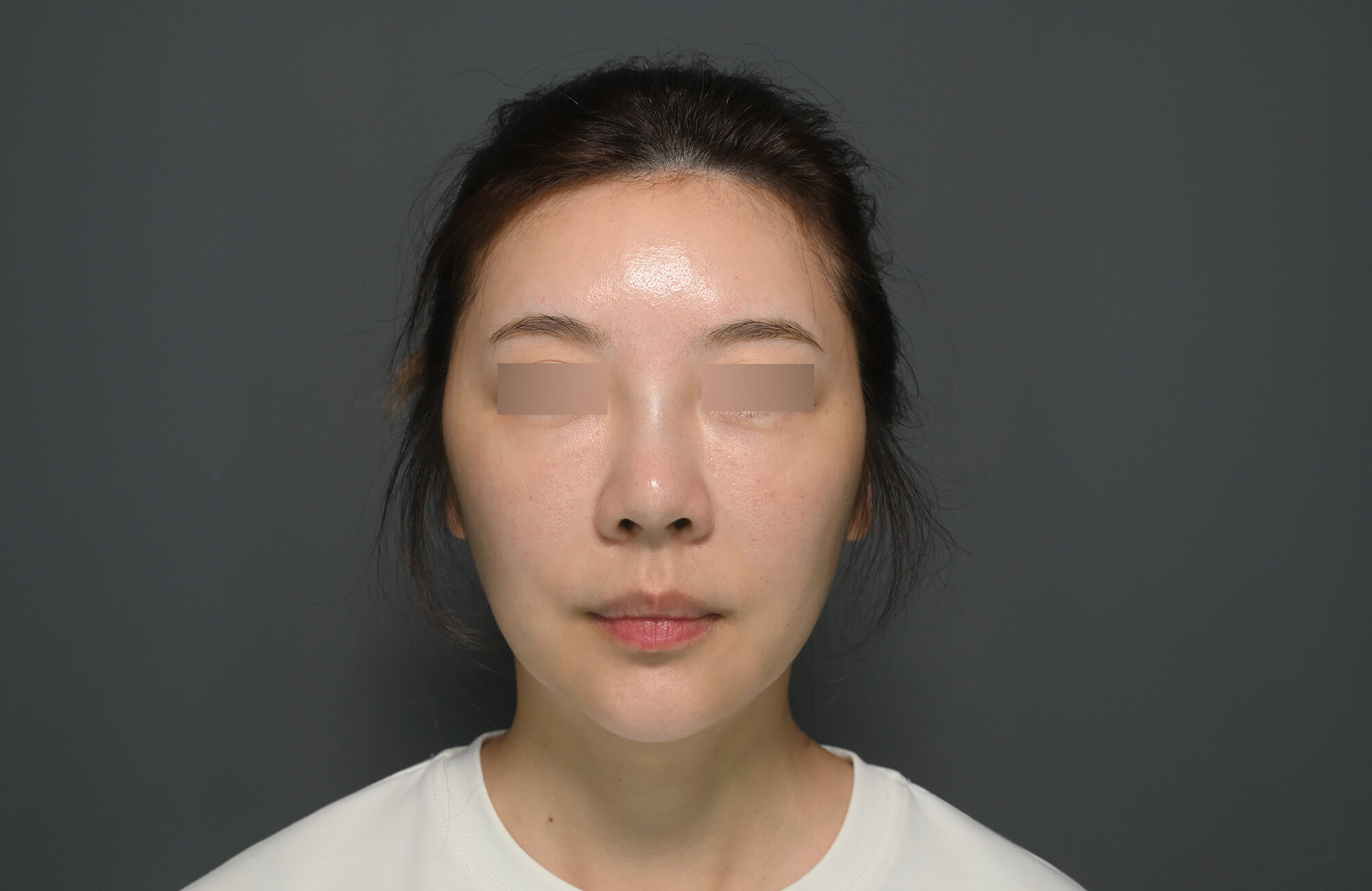 【海芙電音雙波】療程前Before-小嫚